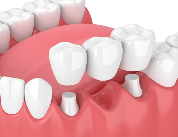 What Are Dental Bridges.jpg